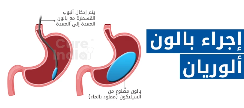 عملية بالون المعدة في الهند